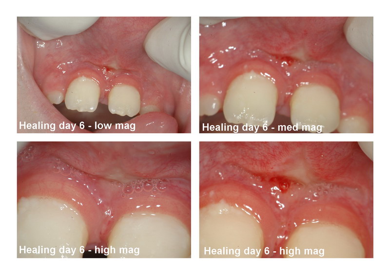 Frenectomy healing day 8_resize.jpg